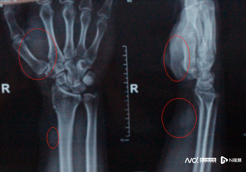 imagefile 男子手腕十余个血管瘤(1)503.png