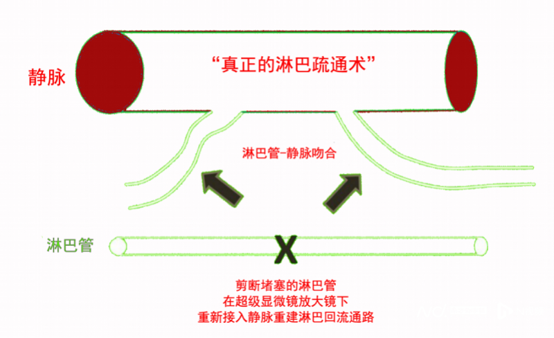 imagefile 副本皮肤肿胀如象皮,超级显微外科让淋巴水肿治疗不再是难题913.png